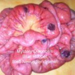 Mystery Diagnosis: Blue Rubber Bleb Nevus Syndrome! IMG_6322