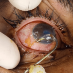 eye