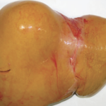 Mystery Diagnosis: Fatty Cirrhosis Caused By Chronic Alcohol Abuse Screenshot 2025-12-15 at 4.13.15 PM